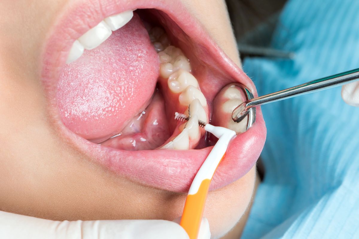 Interdentalbürste